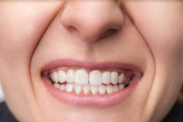 After Dental Implants