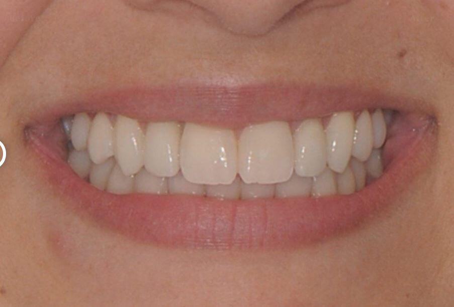 After Dental Implants