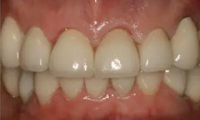 After Dental Implants