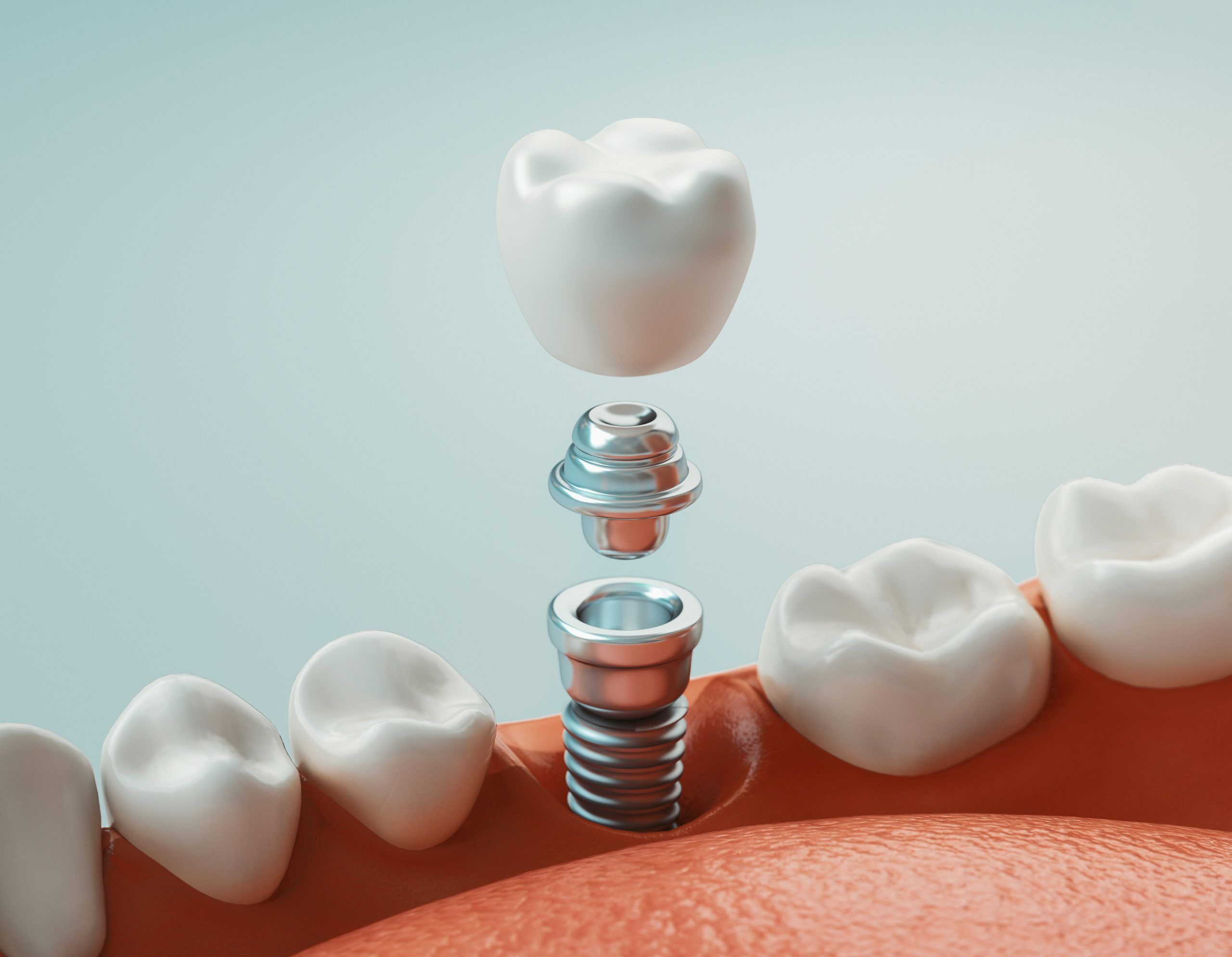 Dental Implants - Advanced Health Dental Centre