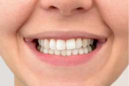 After Dental Veneers