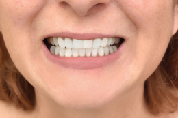 After Dental Veneers