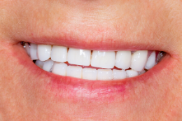 After Dental Veneers